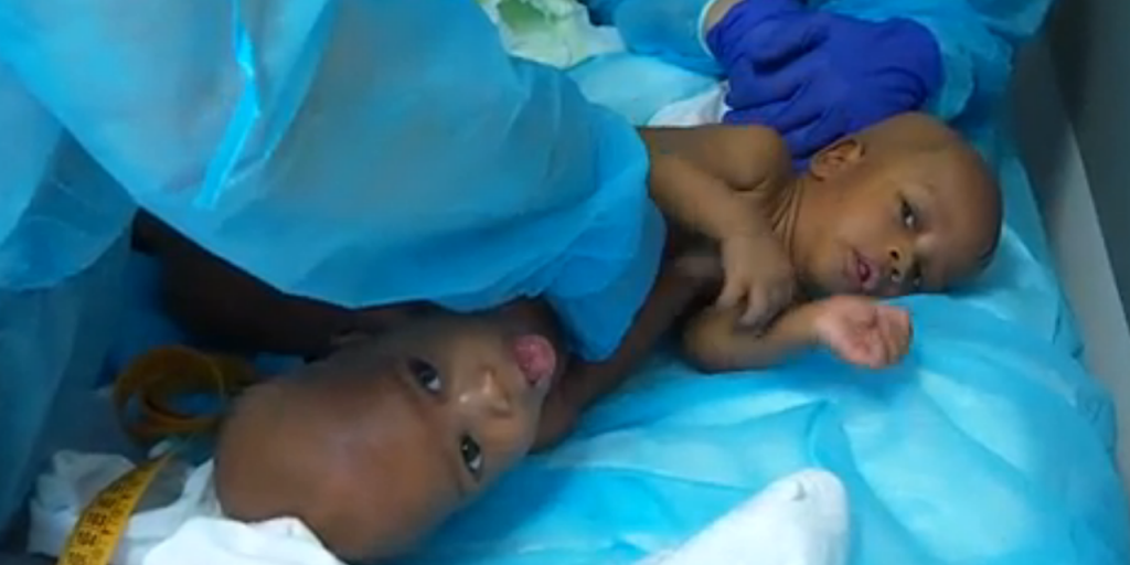 Des-bebes-siamois-separes-avec-succes-a-l-hopital-Necker