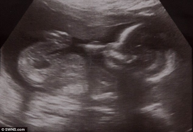 grossesse ditopique encore enceinte extra uterine