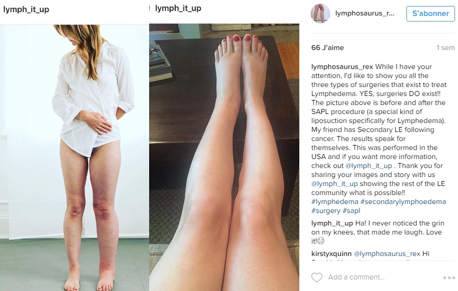 Sarah-Buller-oedeme-lymphatique-jambe-grossesse-instagram2