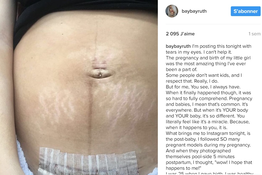 cicatrice-cesarienne-photo-instagram-maman