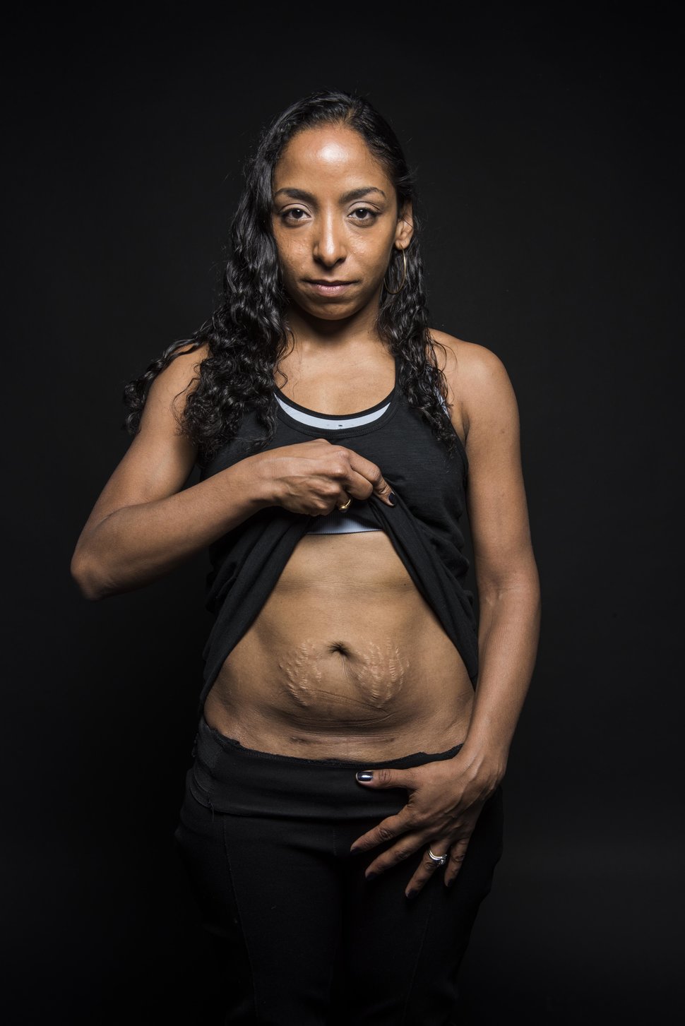 photo-femme-cicatrice-cesarienne-1