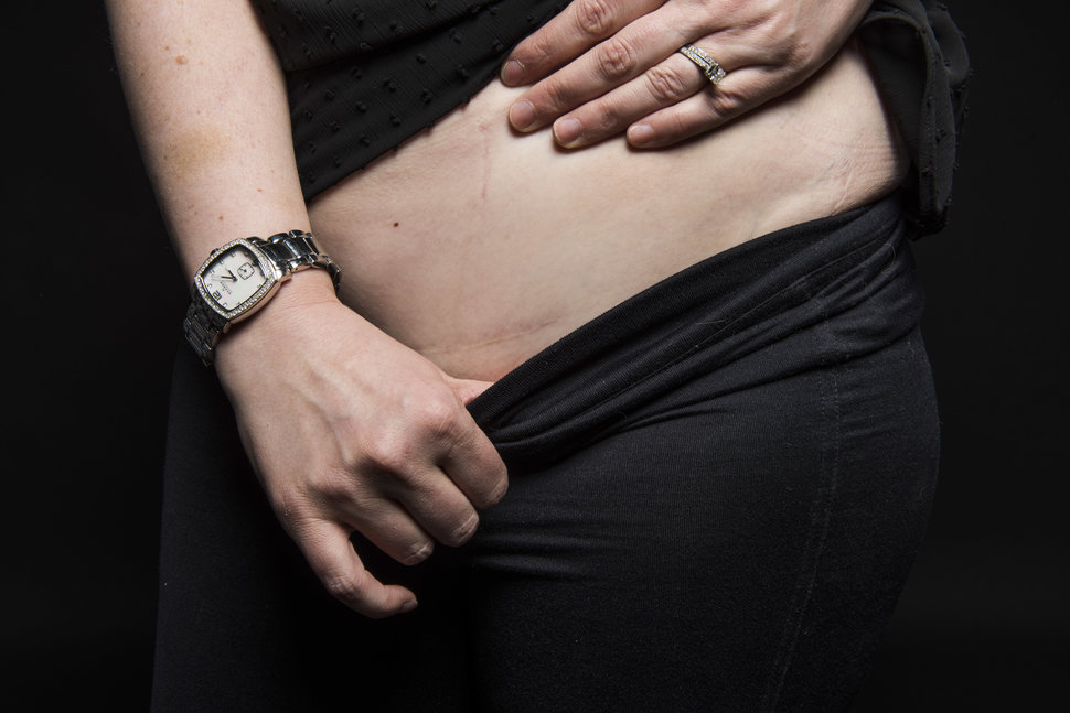 photo-femme-cicatrice-cesarienne-7