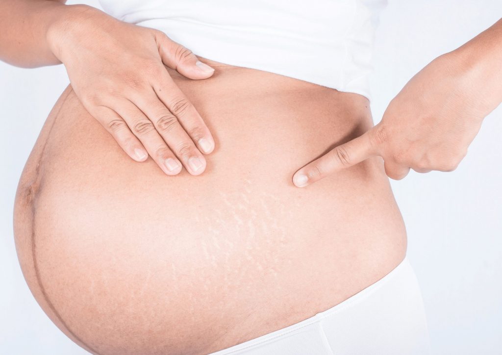 ventre vergetures femme enceinte