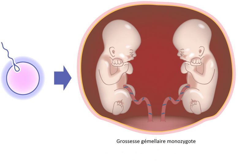 Grossesse gémellaire monozygote Neufmois.fr — free download
