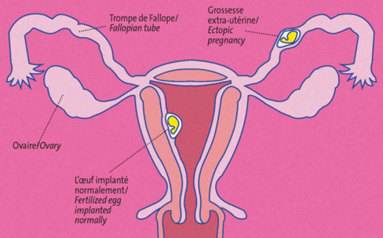 grossesse-extra-ut-rine-neufmois-fr